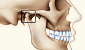 DISFUNÇÃO DA ARTICULAÇÃO TEMPORO MANDIBULAR