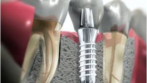 IMPLANTES DENTÁRIOS