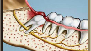 REMOÇÃO DE DENTES INCLUSOS